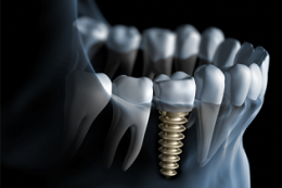 Implantes dentários